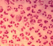 Gonorrhoea STI STD infection