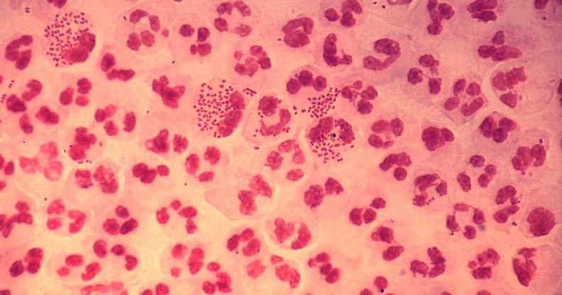 Gonorrhoea STI STD infection