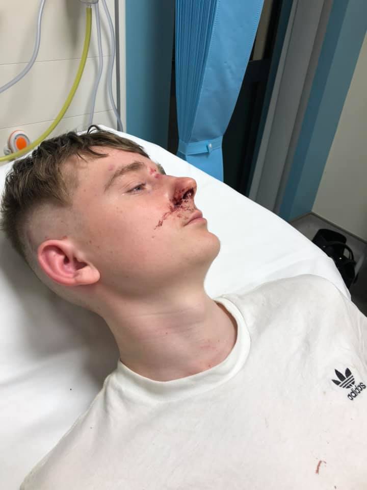 A teenage boy lying in a hospital bed with a bloodied nose