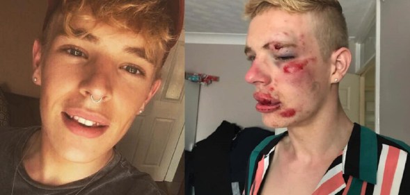 Ryan Turner was beaten up for being gay