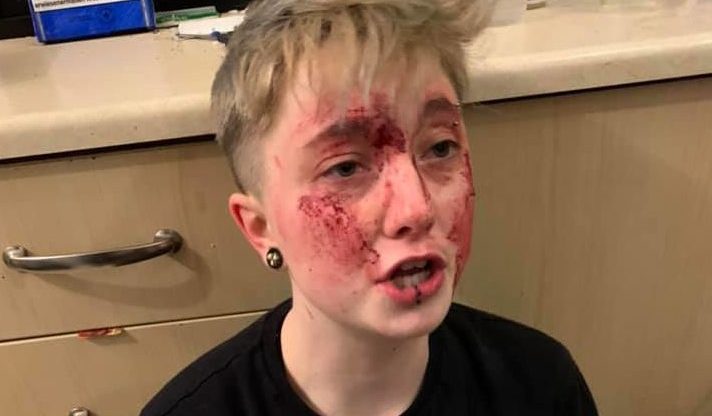 Charlie Graham, 20, was jumped by two homophobic individuals in Sunderland, England. (Michelle Storey/Facebook)