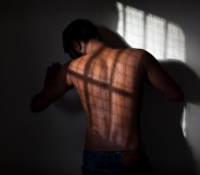 A man's back covered in scars