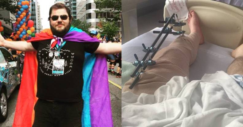 Justin Morissette wearing a rainbow flag as a cape / his leg with metalwork after surgery