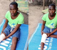 Canary Murungi sits on a UNCHR mat with his knee bandaged