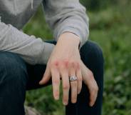 A person who is wearing a grey top and dark bottoms and a ring sits in a grassy area with bruised knuckles