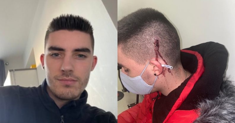 Side-by-side photos of Harry Batt, one of him smiling indoors and another of a cut on the side of his head