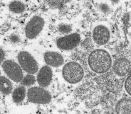 Microscope image of the monkeypox virus