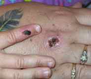 Monkeypox lesions