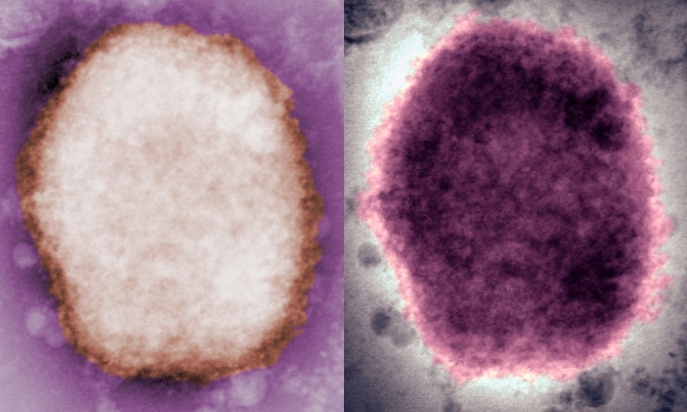 The monkeypox virus under a microscope.