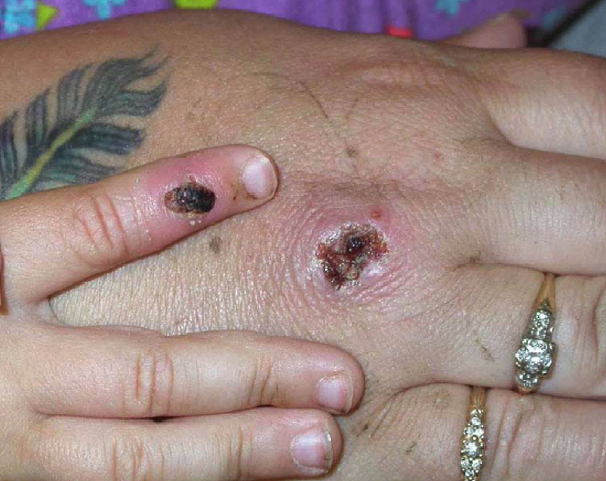 Monkeypox scabs. 