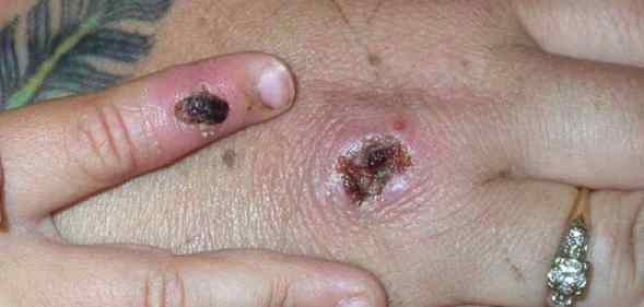 Monkeypox scabs.