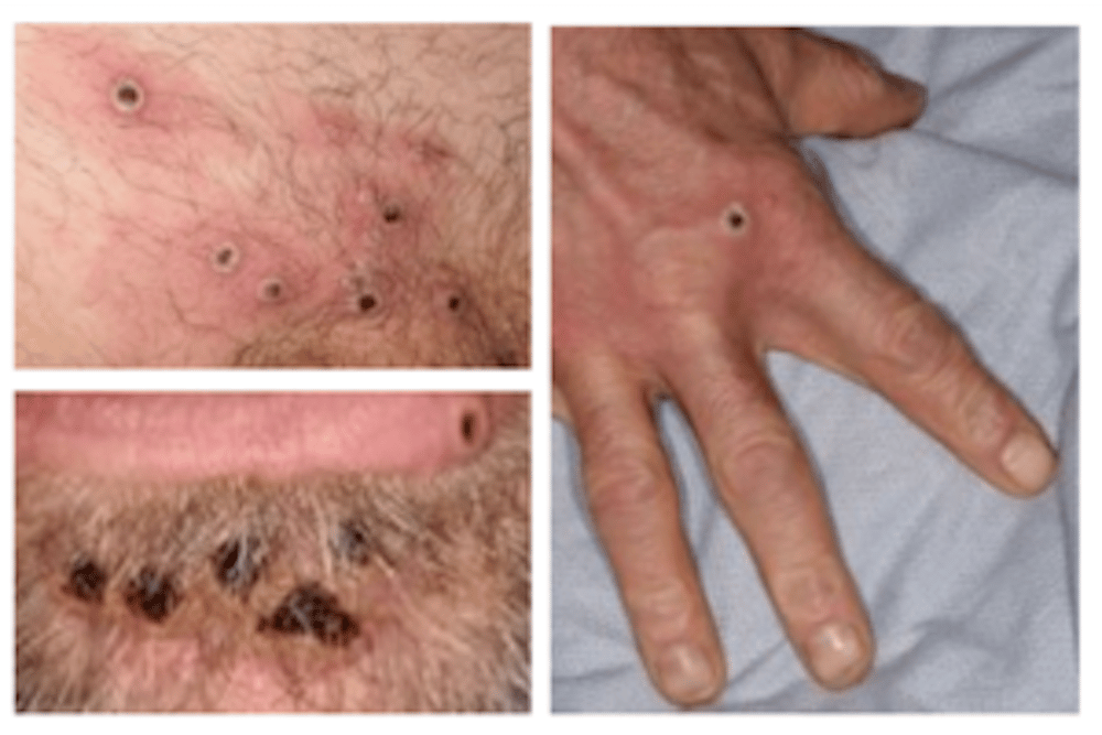 Monkeypox lesions