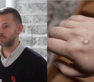 Gay man recalls 'total nightmare' of contracting 'agonising' monkeypox at Pride