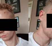 Two side by side photos of one victim of the homophobic attack in London, showing his injuries but censored to ensure anonymity