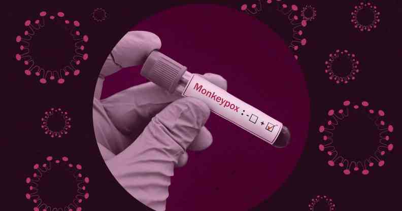 A graphic with a dark purple tint across it and a virus image to the side shows a picture of a hand holding a test tube with monkeypox written on it