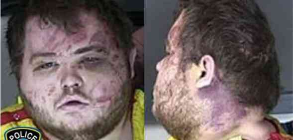 Two mugshots of the Colorado Springs shooter Anderson Lee Aldrich showing severe bruises to his face and neck