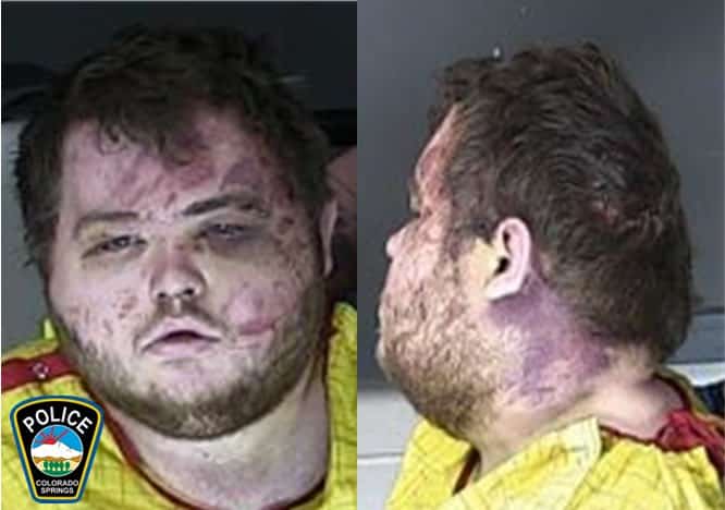 Two mugshots of the Colorado Springs shooter Anderson Lee Aldrich showing severe bruises to his face and neck