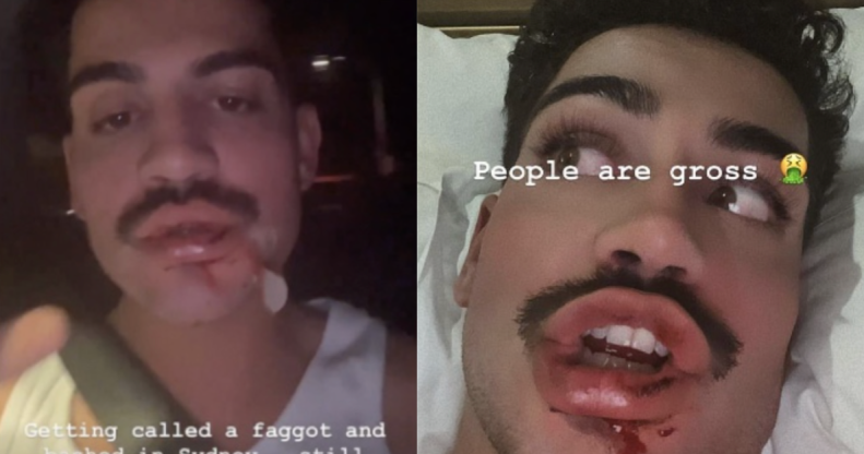 I’m A Celeb star David Subritzky left bloodied in 'homophobic' attack while on night out in Sydney